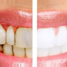 Διαταραχές της δομής ή του χρώματος των δοντιών