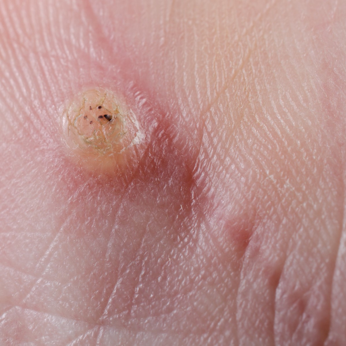 Συχνές βλάβες χεριών-ποδιών κοντά στα νύχια